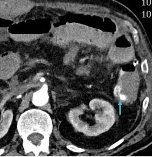 <p>66 let, hematohezija, hemodinamsko nestabilen</p><p></p><ol><li><p>Imenuj tehniko slikanja </p></li><li><p>Kateri organ je prikazan? </p></li><li><p>Diagnoza? </p></li><li><p>Zdravljenje? </p></li><li><p>Najpogostejši vzrok?</p></li></ol><p></p>