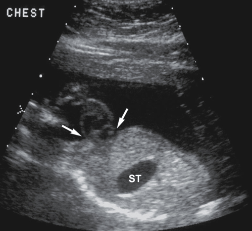 <p>Heart located either partially or completely outside the chest</p>