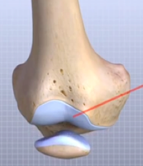 <p>between patella and patellar surface of femur</p>