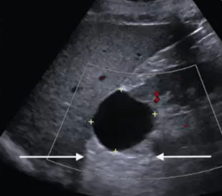 <p>___% of adults over the age of ___ have renal cysts.</p>