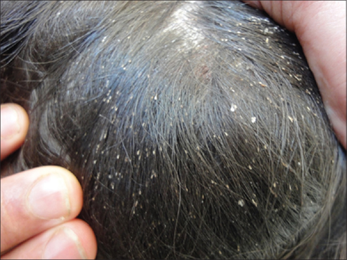 <ol><li><p><span style="color: rgb(216, 200, 38);"><strong>1% permethrin </strong></span>shampoo</p></li><li><p><span style="color: rgb(63, 114, 175);"><strong>benzyl alcohol</strong></span></p></li><li><p><span style="color: rgb(32, 175, 74);"><strong>comb </strong></span>through hair daily for nits</p></li></ol><ul><li><p>can take months</p></li><li><p>boil brushes</p></li></ul><p></p><p></p>