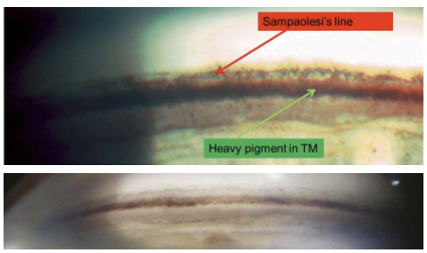 <p>Pigment accumulates in the trabecular meshwork, obstructing aqueous outflow and increasing IOP.</p>
