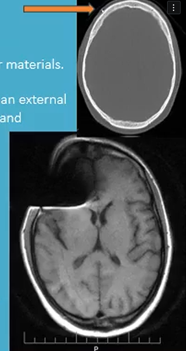 <p>Susceptibility artifact occurs due to differences in magnetic susceptibility between tissues or materials</p>