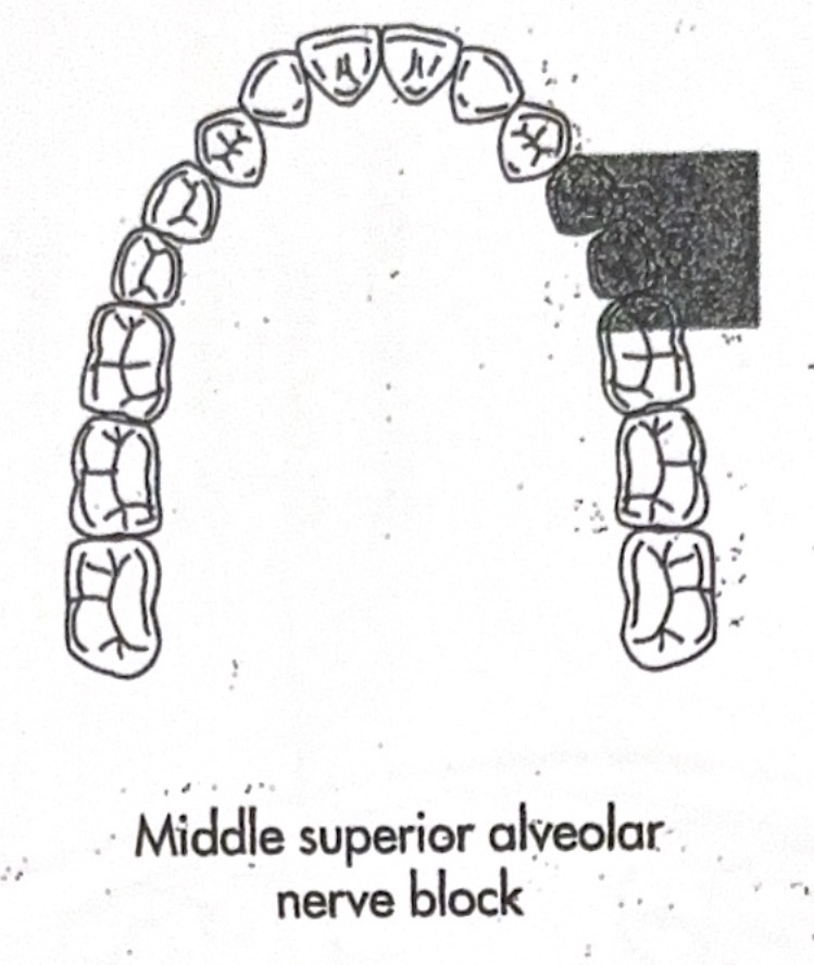 <p>mucobuccal fold at apex of maxillary 2nd premolar</p>