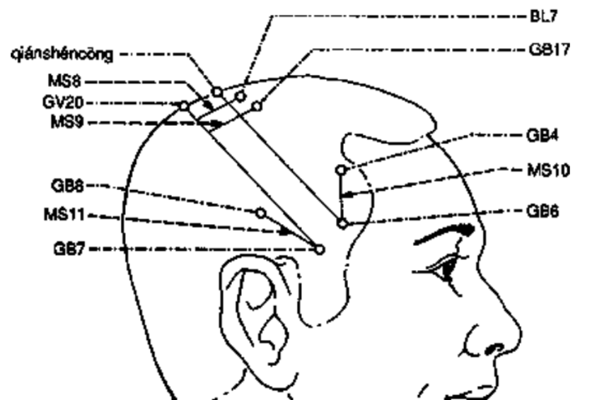 <p>1.5 cun lateral to the middle line of the vertex/DU20, needled</p><p> 1.5 cun long from GB 17 in the direction of DU20</p><p>-diseases of the shoulder, arms &amp; hands like paralysis, numbness and pain</p>