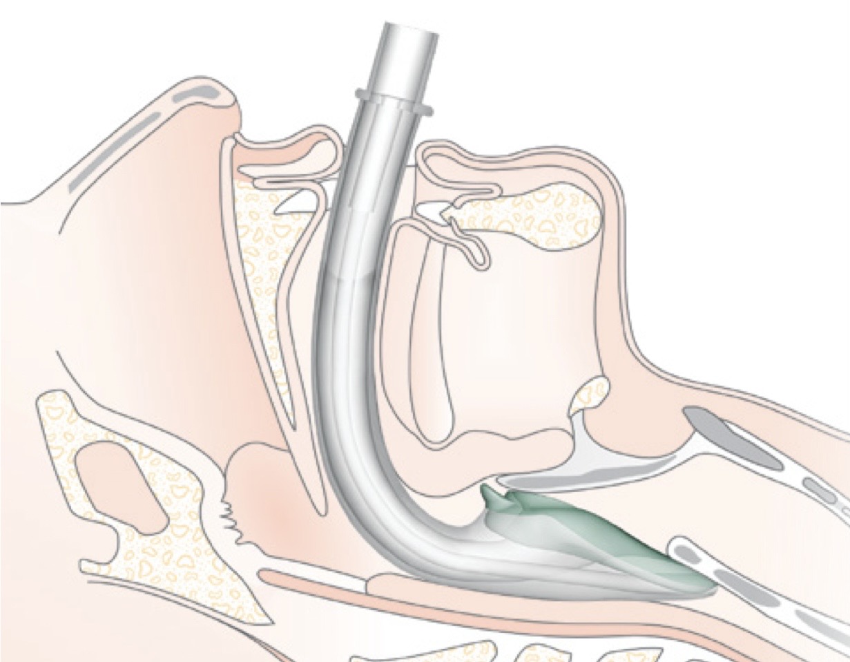 <ul><li><p>hold from tip of the stiffer part of the upper iGEL</p></li><li><p>advance tube until the base of the connector is aligned with teeth/gums (or resistance is felt)</p></li></ul><p></p>