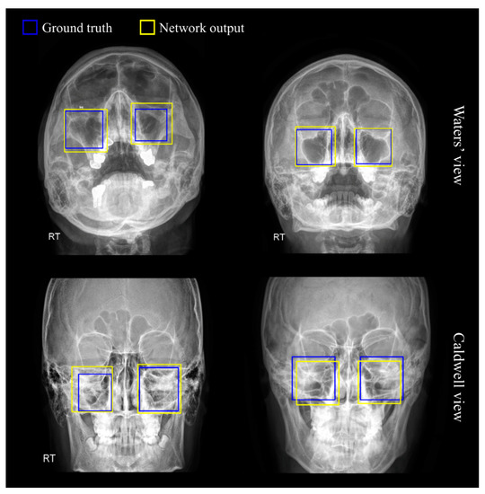 <p>Caldwell view - Flat plate (plain x-ray); nose and forehead placed against the cassette; good view of hard palate, obital floor, nasal septum, and zygoma</p><p>Waters view - flat plate (plain x-ray film) with neck hyperextended; patient stands or sits upright; nose and chin against the cassette; view of frontal/maxillary sinus and infraorbital rim</p>
