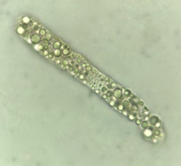 <p>Seen with oval fat bodies/free fat droplets in lipiduria</p><p>Seen with nephrotic syndrome, Diabetes, and crush injuries</p>