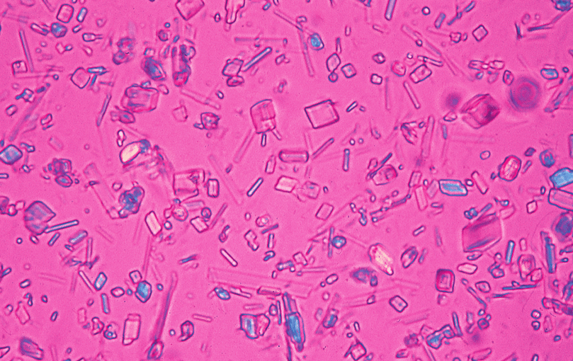 <p>positively birefringent, rhomboid crystals</p>