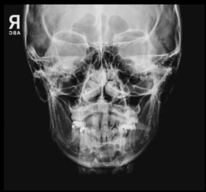 <p>Caldwell’s facial bones demonstrates:</p>