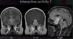 <p>With the patient's history of blindness, which structure is likely involved in the patient's condition? </p><p>a. Cranial nerve II </p><p>b. Corpus colosum </p><p>c. Optic chiasm </p><p>d. Cranial nerve III</p>