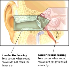 <p>refers to problems with the mechanics of the outer or middle ear and means that sound vibrations cannot be passed from the eardrum to the cochlea - corrected with a hearing aid</p>