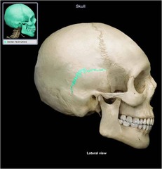 <p>suture between temporal and parietal bones</p>