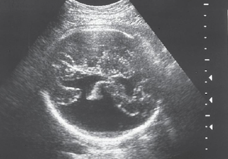 <p>clefts in the cerebral mantle with communication between the ventricles and subarachnoid space</p>