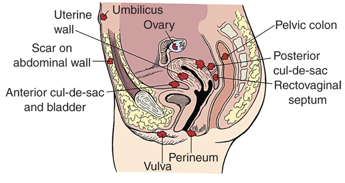 <p>What are causes of Endometrosis?</p>