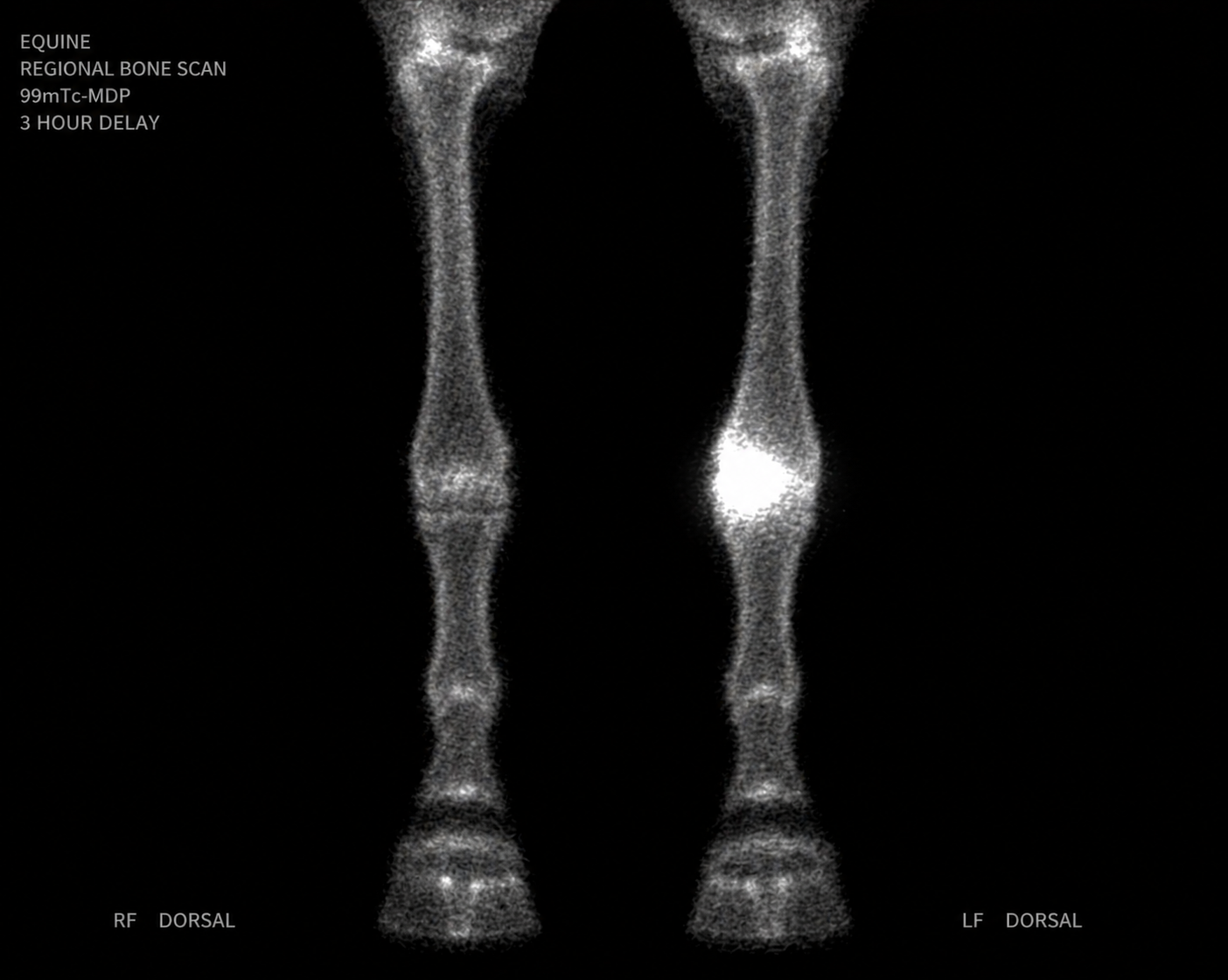 <p>High Voltage presents with a 6-week history of intermittent right forelimb lameness that has been difficult to localize. Nerve blocks have been inconclusive. Radiographs of the foot, fetlock, and carpus are all within normal limits.</p><p>A bone scintigraphy study is performed. A radiotracer (technetium-99m labeled methylene diphosphonate) is administered intravenously. The tracer is taken up by osteoblasts — bone cells actively involved in remodeling. Gamma radiation emitted by the tracer is detected by a gamma camera to produce the image.</p><p>The scintigraphy image shows a focal region of markedly increased tracer uptake in the right proximal metacarpal region — a finding that was not visible on any radiographic view.</p><p>Equine forelimb nuclear scintigraphy</p><p></p><p><strong>Which explanation best accounts for why the scintigraphy image reveals a finding that the normal radiographs did not — and correctly identifies what the focal increased uptake represents?</strong></p><p>a. The scintigraphy image shows greater bone density than radiography because the radiotracer accumulates in calcium-rich bone, and denser bone produces a stronger signal — the hotspot represents an area of mineralization not yet detectable on radiography.</p><p>b. The scintigraphy image has higher spatial resolution than radiography, allowing it to detect subtle structural abnormalities in cortical bone that are too small to be visible on standard projections.</p><p>c. Scintigraphy detects physiologic activity rather than anatomy — the radiotracer accumulates in areas of increased osteoblastic turnover, producing increased signal before structural changes are visible on radiography. The hotspot indicates a region of elevated bone metabolic activity at the proximal metacarpus, identifying the source of lameness that structural imaging cannot yet show.</p><p>d. Scintigraphy uses a stronger radiation source than radiography, allowing deeper penetration into the limb and detection of lesions obscured by overlying soft tissue on standard radiographic projections.</p>
