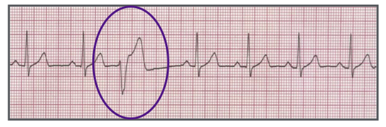 <p>Identify the above waveform:</p><p>a. Atrial flutter</p><p>b. Atrial fibrillation</p><p>c. PVC (premature vent contraction)</p><p>d. PAC (premature atrial contraction)</p>