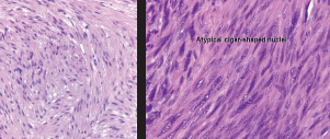<ul><li><p>leiomyoma (uterine mass) → low mitotic</p><ul><li><p>eosinophilic spindle cell, blunt nuclei, <strong>SM actin, desmin,</strong> caldesmon</p></li></ul></li><li><p>leiomyosarcoma (retroperitoneal) →<strong> cigar-shape </strong>nuclei, high mitotic, necrosis</p></li></ul><p></p>