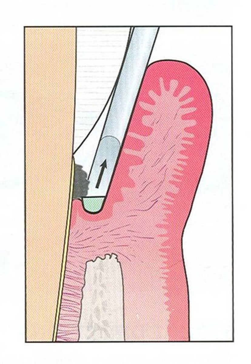 <p>Bottom up approach</p><p>• from the base of the pocket toward the CEJ.</p><p>•Curet positioned under deposit</p>