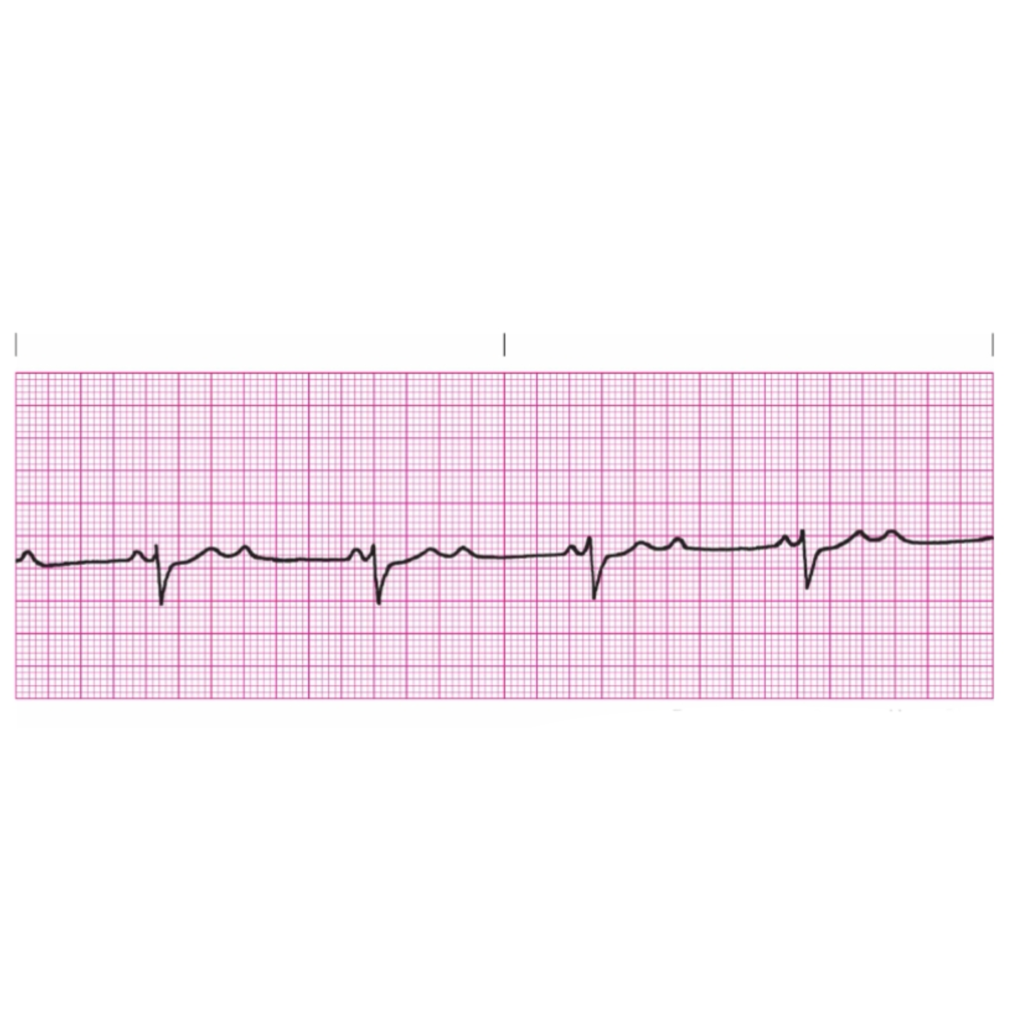 <p class="is-empty is-editor-empty has-focus">Rules for Type II Second Degree Heart Block includes </p>