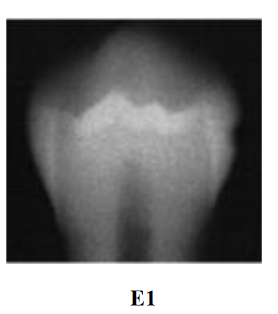 <p>Radiolucency in the outer half of enamel</p>