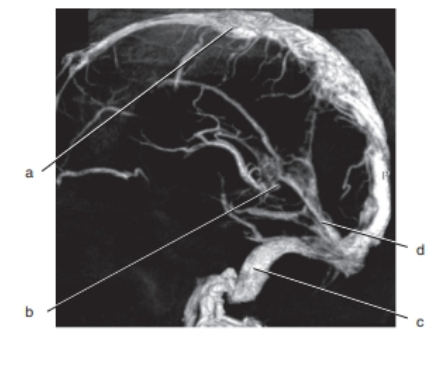 <p>Which letter is the superior sagittal sinus ?</p>