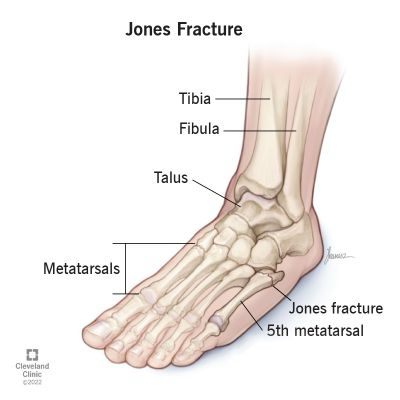 <p></p><ul><li><p>Avulsion of the Peroneus Brevis / Fracture of the 5th Metatarsal</p></li><li><p>Caused by Inversion / Lateral Ankle Sprain</p></li><li><p>Should be suspicious of this if your patient complains of pain distally</p></li></ul><p></p>