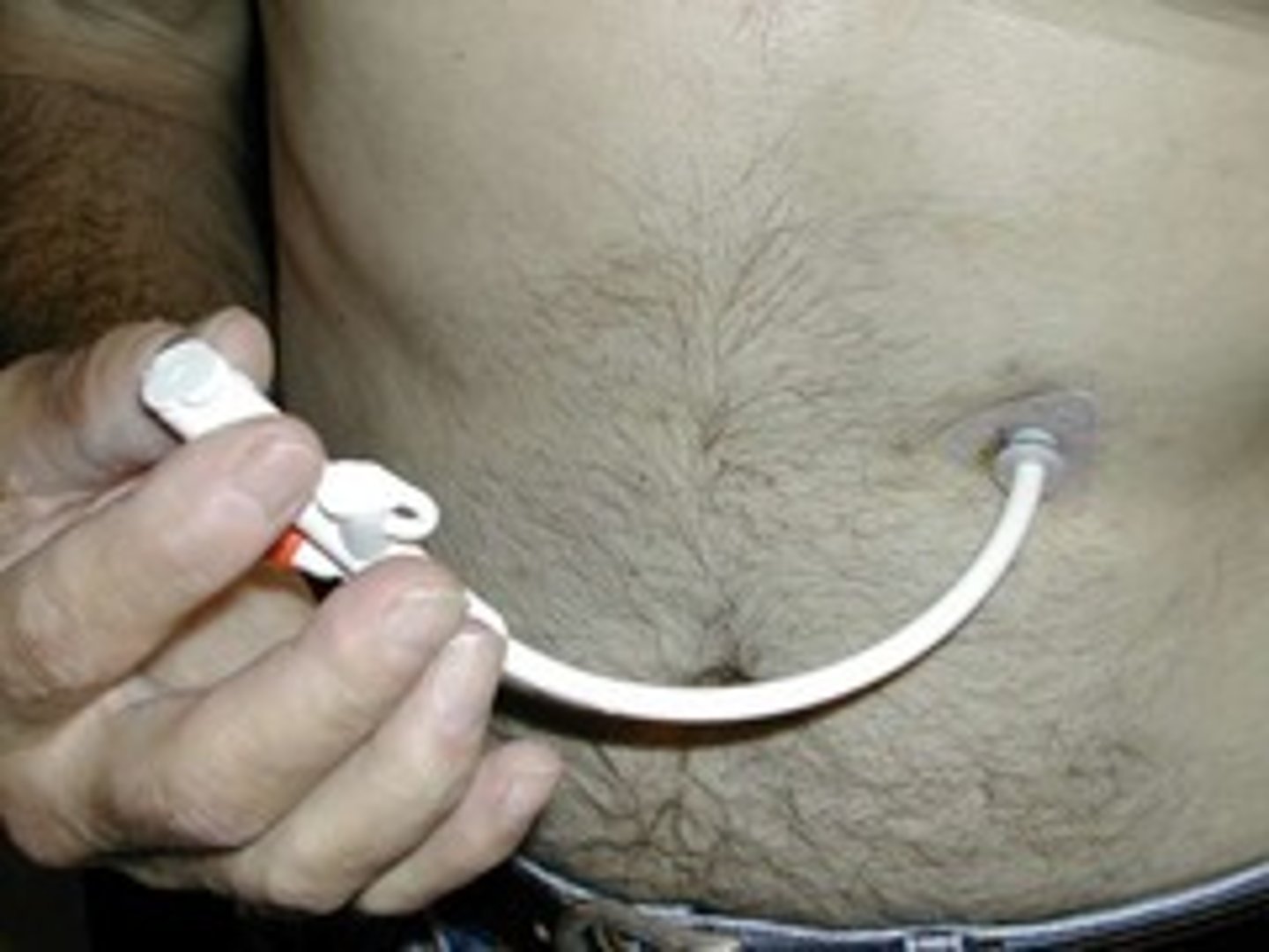 <p>percutaneous endoscopic gastrostomy tube - feeding tube</p>