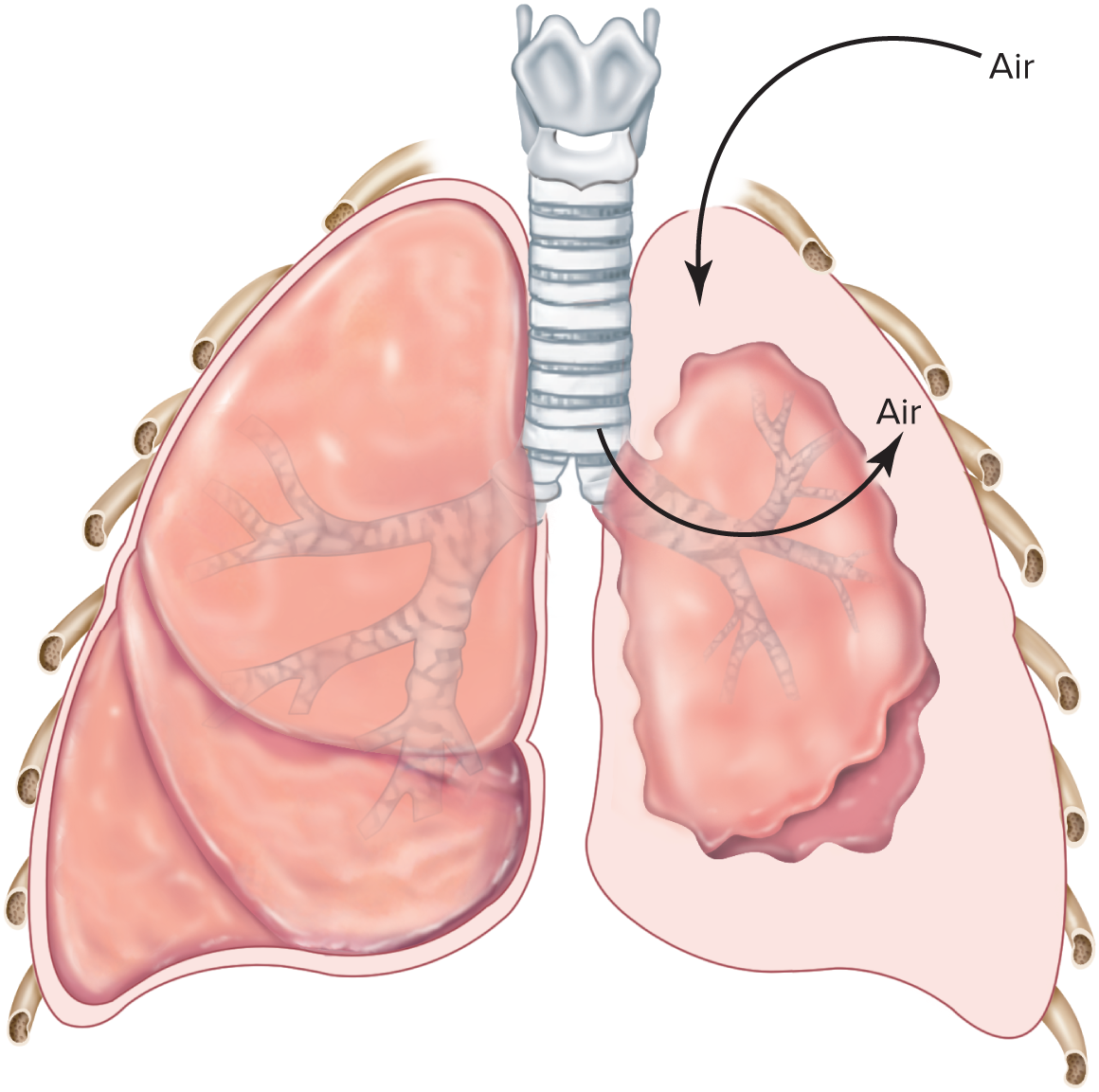 <p><span style="color: red;"><strong>Collapsing of lungs </strong></span>that occurs during surgery or trauma when chest wall is pierced without damaging lung and<span style="color: purple;"> </span><mark data-color="yellow" style="background-color: yellow; color: inherit;">atmospheric air enters intrapleural space</mark> (P<sub>ip</sub>= -4 mmHg → 0 mmHg)</p><p></p><p><u>i.e.</u> <mark data-color="yellow" style="background-color: yellow; color: inherit;">P<sub>ip</sub> = P<sub>atm</sub></mark> <u>or</u><span style="color: purple;"> </span><strong><mark data-color="yellow" style="background-color: yellow; color: inherit;">P<sub>ip</sub> becomes positive</mark>/higher pressure <em>than</em> P<sub>alv</sub></strong></p><p><strong>→ </strong><span style="color: red;"><strong>P<sub>tp</sub></strong></span><strong> = P<sub>alv </sub><mark data-color="yellow" style="background-color: yellow; color: inherit;">- P<sub>ip</sub></mark> = +</strong><span style="color: red;"><strong> </strong></span><strong><mark data-color="yellow" style="background-color: yellow; color: inherit;">-(+)</mark></strong><span style="color: red;"><strong> = 0 </strong></span><span style="color: red;"><strong>(eliminated)</strong></span></p><p>→ moves across wall towards lower pressure (P<sub>alv</sub>) → <span style="color: red;"><em>collapsing of lungs</em></span></p>