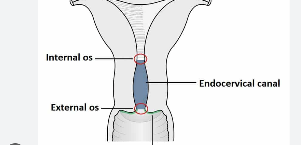 <p><mark data-color="rgba(0, 0, 0, 0)" style="background-color: rgba(0, 0, 0, 0); color: inherit;">two openings of the uterine cervix</mark><span>. The </span>internal os<span> connects the cervical canal to the uterus, while the </span>external os<span> connects the cervix to the vagina</span></p>