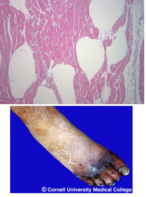 <p>Strict anaerobe, creates gas</p><ul><li><p>Organism: Clostridium perfringens</p></li><li><p>Diagnosis: Gas pockets in deep tissue restrict blood flow → kill tissue</p></li><li><p>Treatment: Debridement; <u>antibiotics</u></p></li><li><p>Epidemiology: Diabetes, childbirth, wound</p></li></ul><p></p>