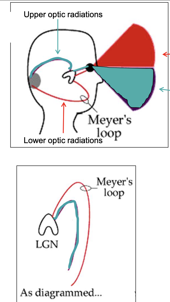 <ul><li><p>upper optic radiation = green </p><ul><li><p>represent lower visual field </p></li><li><p>travels in parietal lobe </p></li></ul></li><li><p>Meyer’s loop (lower optic radiation) = red </p><ul><li><p>represents upper visual field </p></li><li><p>travels in temporal lobe </p></li></ul></li></ul><p></p>
