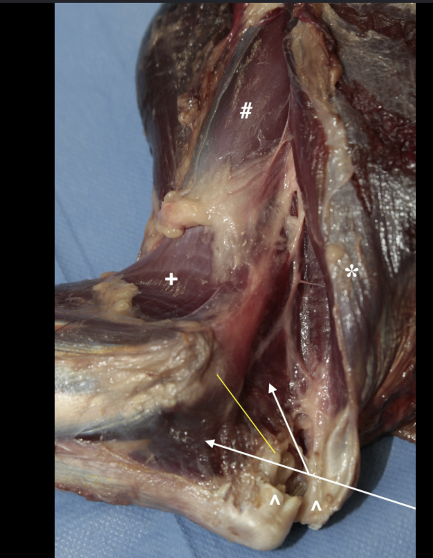 <p>attachments; lateral supracondylar crest and epicondyle of the humerus to the olecranon </p><p>action: extend the elbow joint </p>