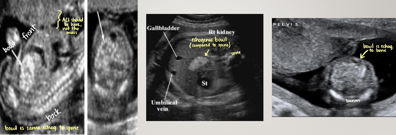 <ul><li><p>mid-lower abdomen; centrally located echogenic areas inferior to liver</p></li><li><p>SONO: varies with menstrual age</p><ul><li><p>mid gut herniation (<12wks)</p></li><li><p>early pregnancy=hypoechoic</p></li><li><p>late pregnancy=more echogenic</p></li></ul></li><li><p><span style="color: red;">hyperechoic bowel is NOT normal</span></p><ul><li><p><span style="color: red;">echogenicity should always be less than bone</span></p></li></ul></li><li><p>may see peristalsis in 3rd trimester (normal)</p></li></ul><p></p>