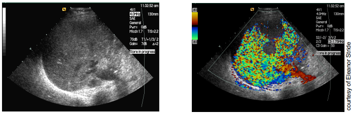 <p>colour doppler mode is used to produce high pressure waves popping the contrast agent</p><ul><li><p>released gas produces strong reflections</p></li><li><p>doppler interprets this as large random velocity fluctuations</p></li><li><p>used for perfusion studies → areas without bubbles → not perfused </p></li></ul><p></p><p>very sensitive but low frame rate </p><p></p>