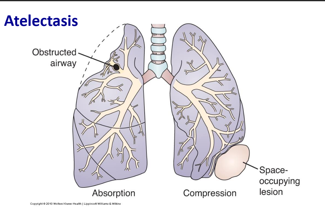 <ul><li><p class="Paragraph SCXO153096343 BCX0" style="text-align: left;"><span style="background-color: inherit; line-height: 20.7px; color: windowtext;"><strong>Collapse of lung tissue deflated alveoli by </strong></span><span style="line-height: 20.7px; color: windowtext;"> </span></p></li></ul><ol><li><p class="Paragraph SCXO153096343 BCX0" style="text-align: left;"><span style="background-color: inherit; line-height: 20.7px; color: windowtext;"><strong>External compression e.g </strong>fluid in pleural space, tumor, abdominal distension </span><span style="line-height: 20.7px; color: windowtext;"> </span></p></li><li><p class="Paragraph SCXO153096343 BCX0" style="text-align: left;"><span style="background-color: inherit; line-height: 20.7px; color: windowtext;"><strong>Obstructed airways: </strong>air is absorbed from obstructed alveoli and they collapse </span><span style="line-height: 20.7px; color: windowtext;"> </span></p></li><li><p class="Paragraph SCXO153096343 BCX0" style="text-align: left;"><span style="background-color: inherit; line-height: 20.7px; color: windowtext;"><strong>Decreased production of surfactant e.g </strong>anesthesia</span><span style="line-height: 20.7px; color: windowtext;"> </span></p></li></ol><ul><li><p class="Paragraph SCXO153096343 BCX0" style="text-align: left;"><span style="background-color: inherit; line-height: 20.7px; color: windowtext;">Clinical manifestations: dyspnea, cough, fever, leukocytosis </span><span style="line-height: 20.7px; color: windowtext;"> </span></p></li><li><p class="Paragraph SCXO153096343 BCX0" style="text-align: left;"><span style="background-color: inherit; line-height: 20.7px; color: windowtext;">Commonly develops after surgery patients in pain breathe shallowly, produce viscous bronchial secretions- narcotics/ anesthesia dry up surfactant </span><span style="line-height: 20.7px; color: windowtext;"> </span></p></li><li><p class="Paragraph SCXO153096343 BCX0" style="text-align: left;"><span style="background-color: inherit; line-height: 20.7px; color: windowtext;">Post surgery patients advised to breathe deeply, become ambulatory asap (start walking), and change positions frequently when laying down </span><span style="line-height: 20.7px; color: windowtext;"> </span></p></li></ul><p></p>