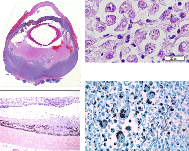 <ul><li><p><strong>pyogranulomatous chorioretinitis</strong></p></li><li><p>primary pulmonary infection with dissemination to GI, liver</p></li><li><p>small round yeast, intracytoplasmic in macrophages</p></li></ul><p></p>