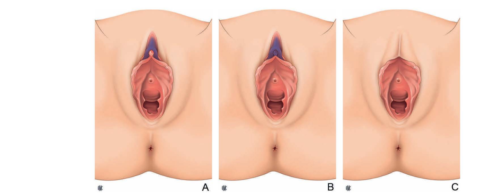 <ul><li><p>Clitoridectomie Consiste en une ablation partielle ou totale du clitoris et/ou du prépuce</p></li></ul><p></p><p></p>