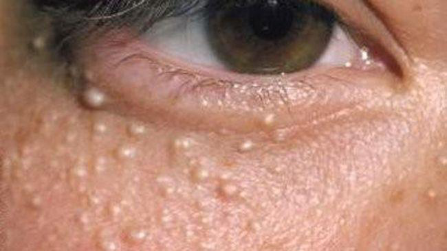 <p>Tiny white or yellowish, firm bumps.</p>