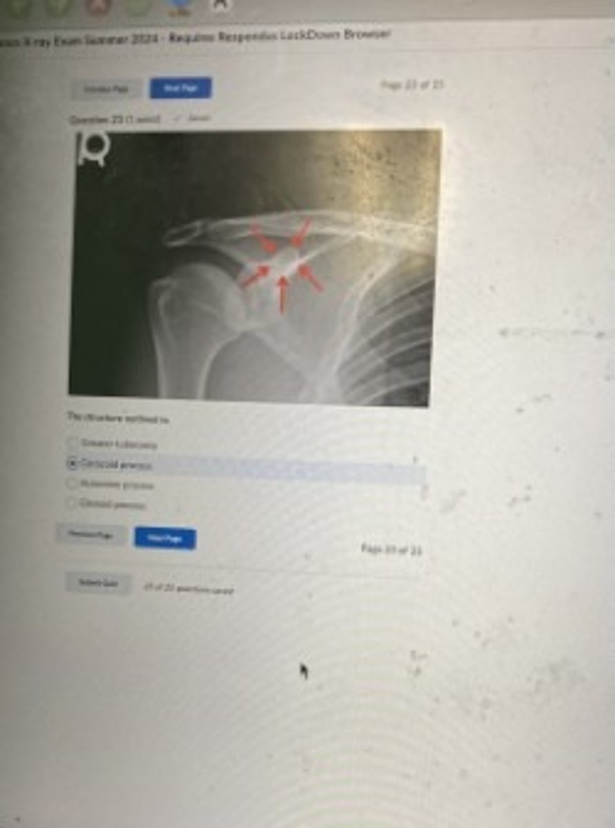 <p>Coracoid process</p>