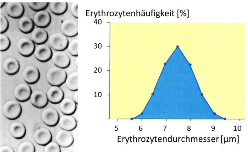 <p><strong>Verfahren Blutausstrich</strong><br></p><ul><li><p>Technik: Bluttropfen abnehmen (z.B. Fingerpieks)</p></li><li><p>Auf Objektträger geben</p></li><li><p>Dann mit der Kante eines zweiten Objektträgers über den Tropfen fahren und ihn dabei auf dem ersten verteilen. Es entsteht ein dünner Blutfilm, der gut unter dem Mikroskop beobachtet werden kann</p></li></ul><p><strong>Größenverteilung der Erythrozyten= Price-Jones-Kurve = Histogramm der Erythrozytendurchmesser</strong><br></p><ul><li><p>Vorsicht: die Price-Jones-Kurve ist keine Gaußglockeverteilung</p></li><li><p>Denn diese würde a) auch negative Durchmesser und b) auch riesig große Durchmesser der Erythrozyten zulassen aufgrund der Unbeschränktheit des Definitionsbereichs der Gaußglocke).</p></li></ul><p></p>