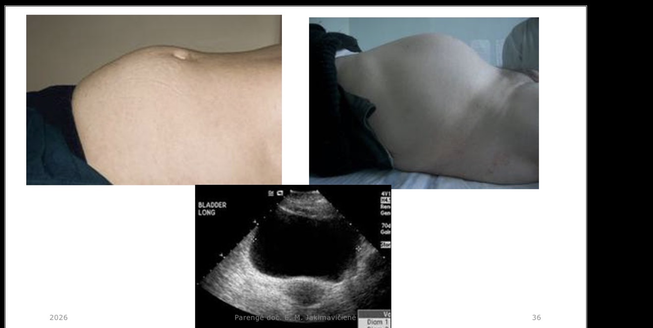 <p>Kada atliekama šlapimo pūslės punkcija (o ne kateterizacija)?</p>