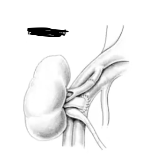 <ul><li><p>less common anastamosis technique </p></li></ul><ul><li><p>connects illiac vessels to renal vessels</p></li></ul><p></p>