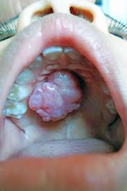 <p>Describe the base of this lesion</p>