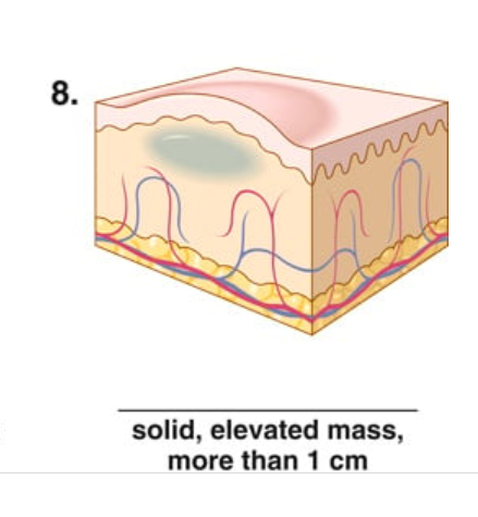 <p>solid, elevated mass, <1cm</p>