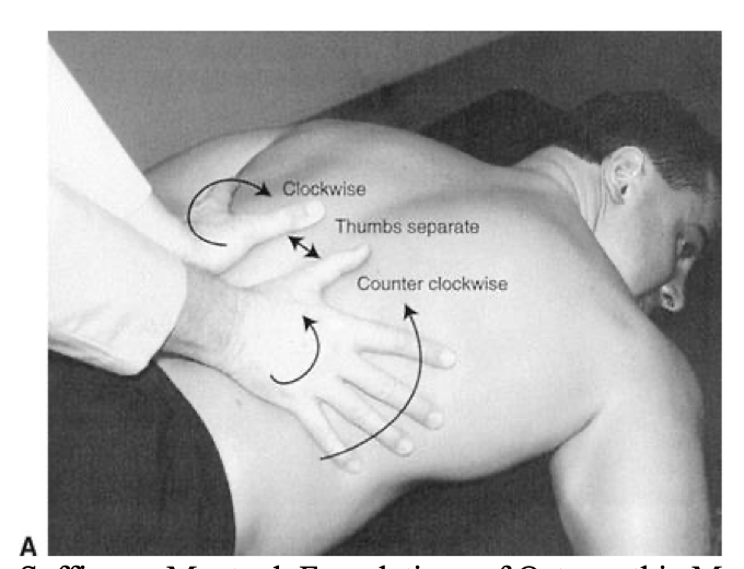 <p></p><p></p><ol><li><p>Patient's hands and arms are comfortably placed either over the sides of the table or on the table beside the hips and thighs.</p></li><li><p>Physician stands beside the patient's hip, facing the patient.</p></li><li><p>The physician's hands are placed at the thoracolumbar junction, covering posteroinferior rib, trunk rotators, and diaphragmatic sites.</p></li><li><p>The physician's hands are placed widely open, with the thumbs pointed superior along either side of the spinous processes, while the remainder of each hand spreads over the posteroinferior costodiaphragmatic and upper lumbar areas.</p></li><li><p>Identify superficial and deep tightness and looseness patterns three dimensionally.</p></li><li><p>Firmly separate the thumbs across the midline as the left hand creates clockwise and the right hand creates counterclockwise traction. The hands should not slide on the skin.</p></li><li><p>As the skin is stretched between the thumbs, it will initially blanch. As compression, traction, and twist are maintained, tissues begin to relax both reflexively and mechanically in accordance with principles discussed earlier in this chapter.<br>a. After initial blanching, the site of major soft tissue tension commonly becomes reddened and warmer, in a process known as the blush phenomenon.</p></li><li><p>Typical releases occur in three dimensions with sustained traction and twist, either singly or in multiples. The latter often creates a wormlike sensation under the palpating hands.<br>a. As multiple releases continue, the unwinding phenomena often occur, as shifting patterns of tightness and looseness alter three-dimensional relationships.<br>b. With practice, the physician learns to feel deeply into the areas surrounding facet joints.<br>c. Symmetric segmental movements to passive three-dimensional stressing suggest that the procedure is complete.<br>d. Treatment is complete when repetitive stressing of selected sites no longer creates release activity.</p></li></ol><p></p>