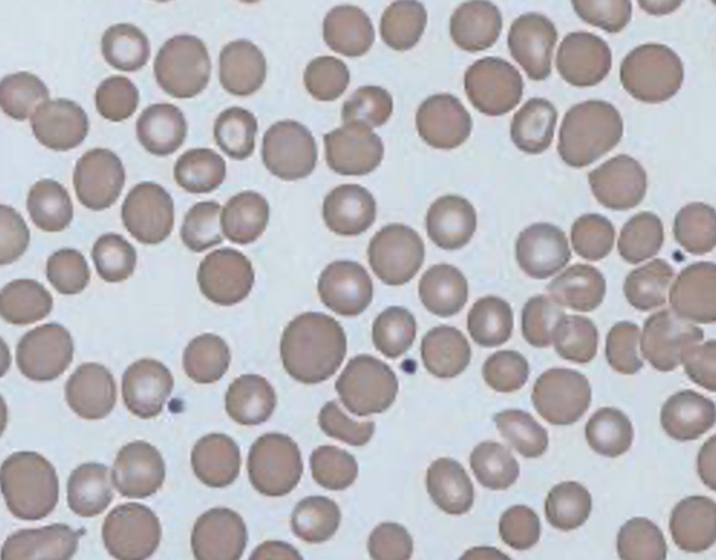 <p>abnormal/ increased variability in size MC caused by Fe deficiency</p>