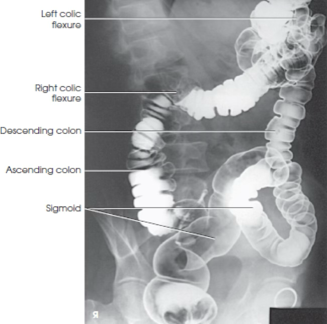 <p>What view is this? Is patient in RAO or LAO?</p>