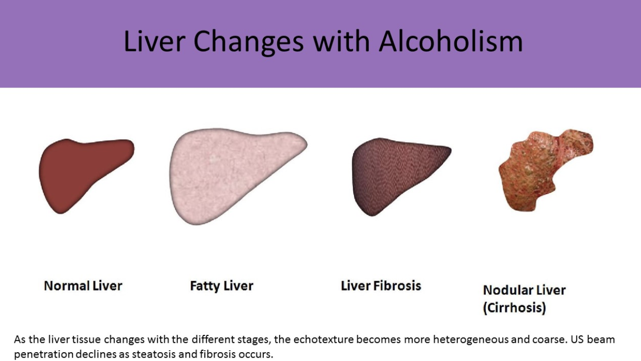 <p>normal → steatosis → fibrosis → cirrhosis </p><ul><li><p>liver becomes smaller, increased heterogeneous echotexture and coarse</p></li></ul><p></p>