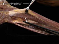 <p>In this posterior view of the right arm, identify the nerve indicated by the arrows.</p>